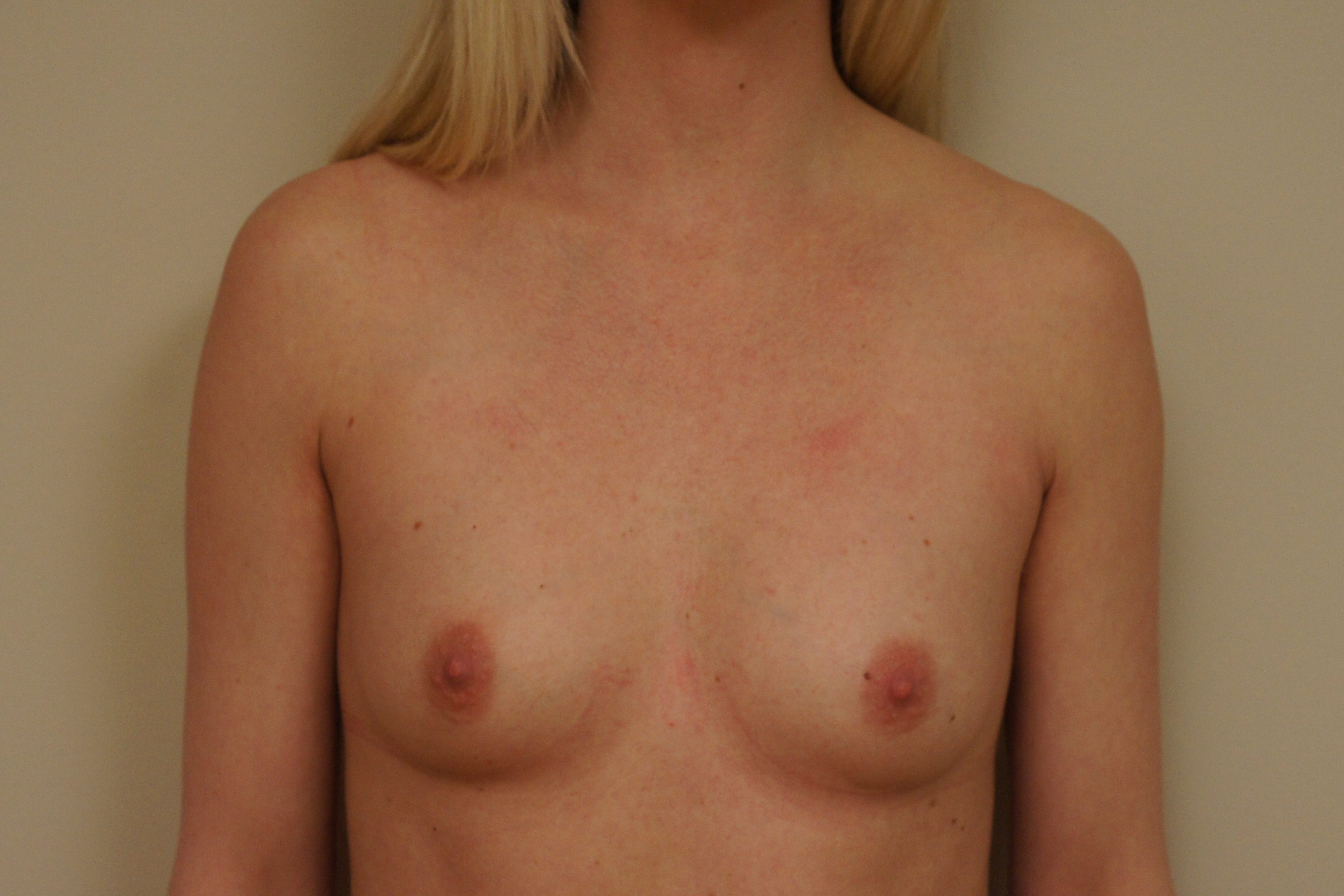 breast-augmentation-before1-1