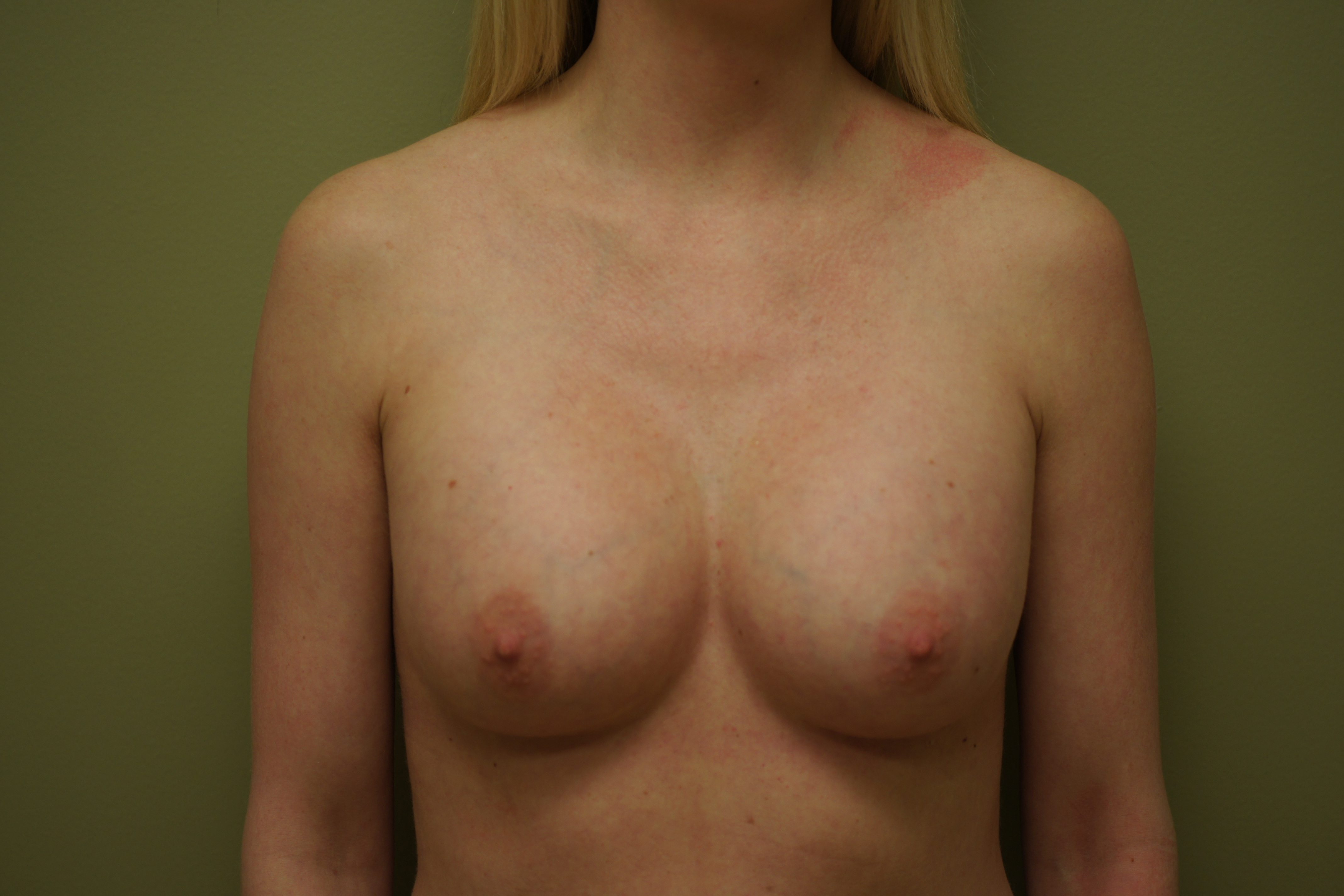 Breast Augmentation 30 day post op