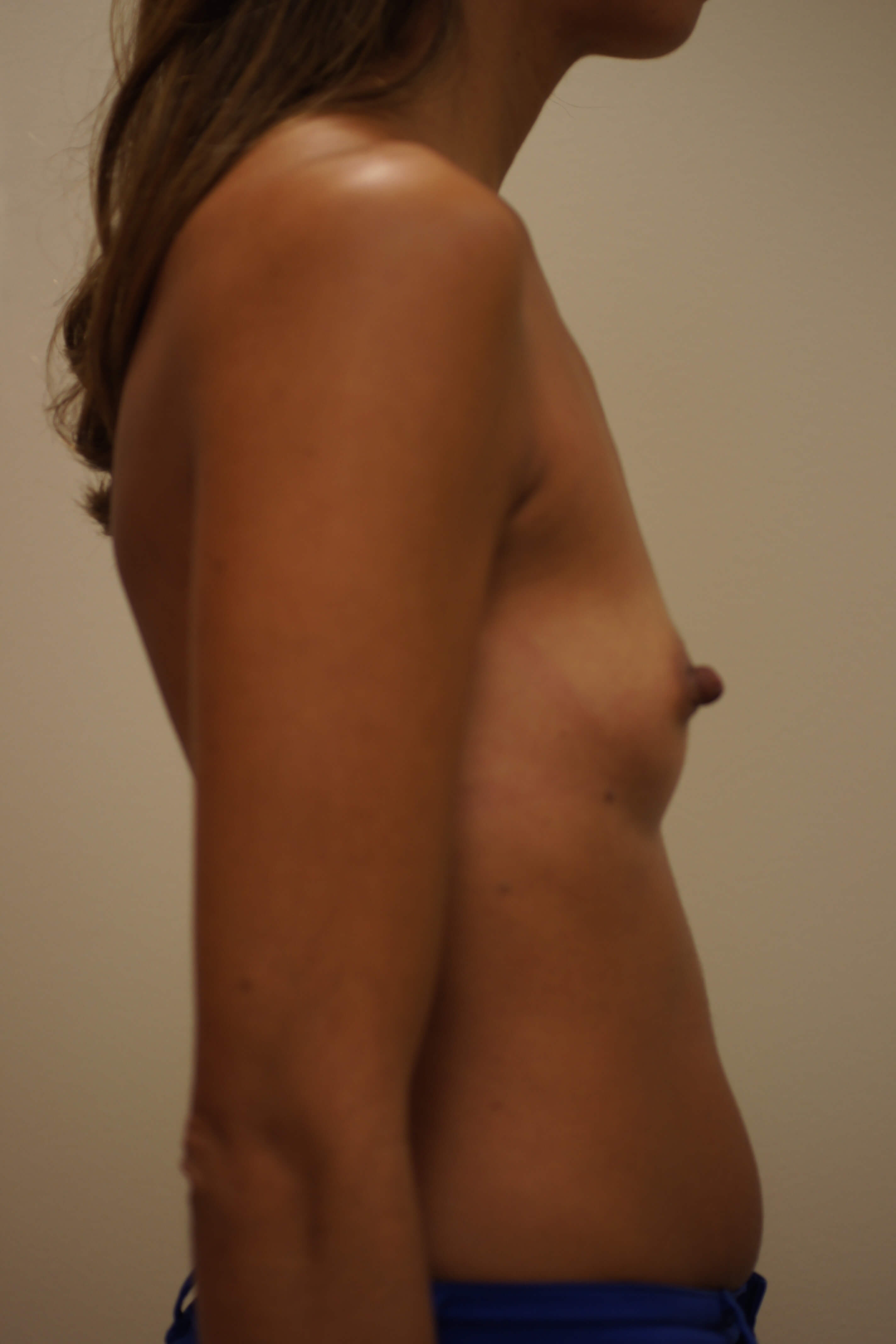 breast-augmentation-before 4