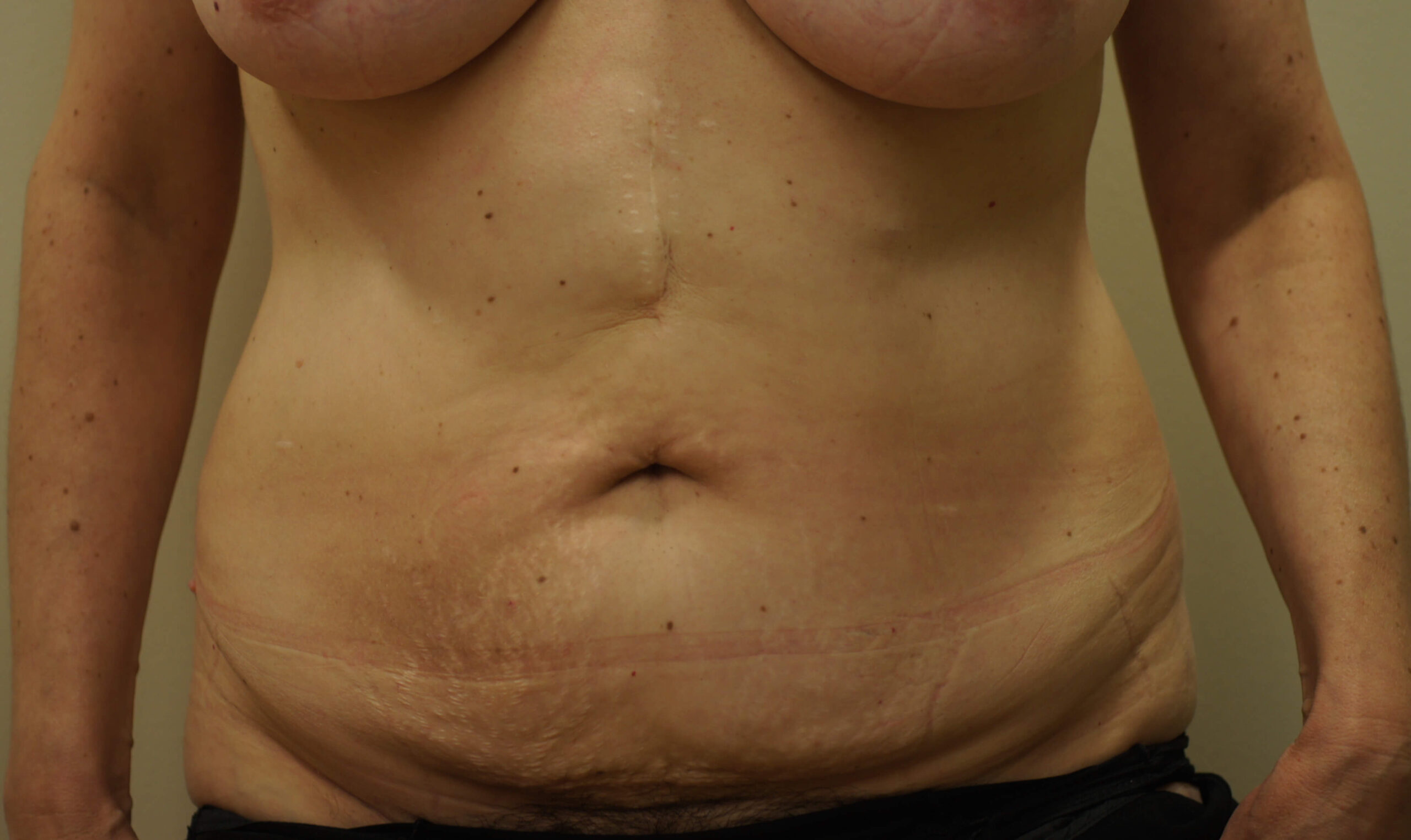 tummytuck Before 1 scaled