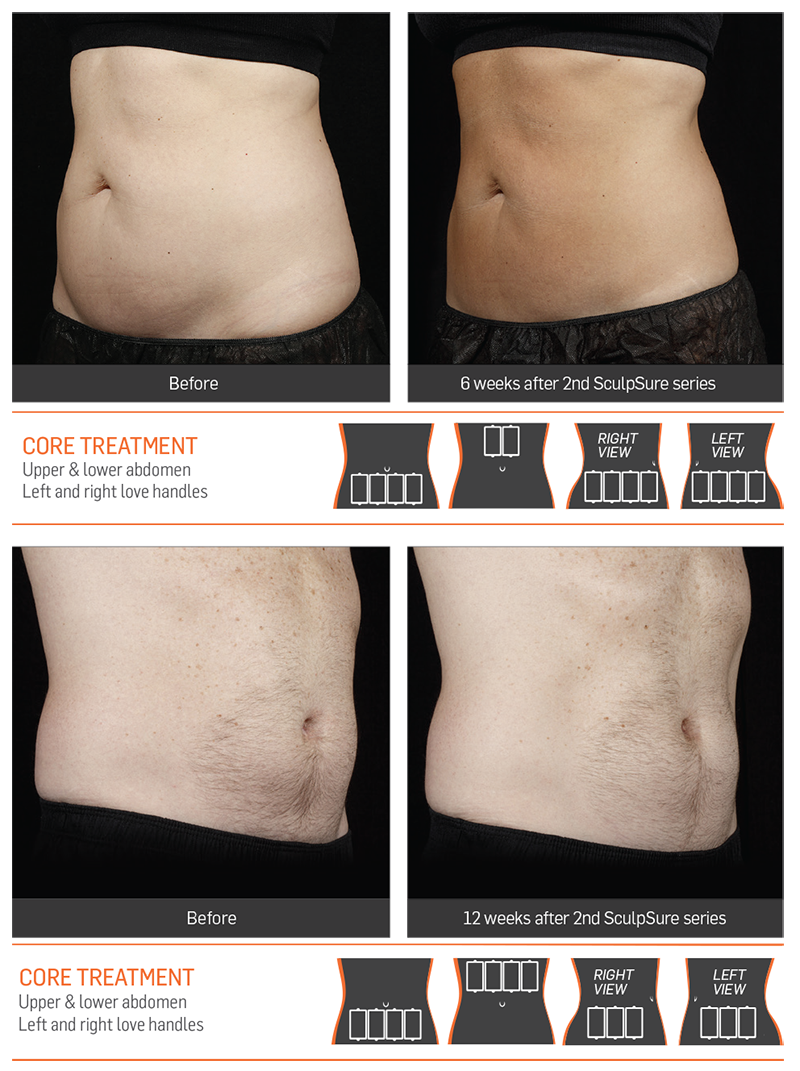 SculpSure